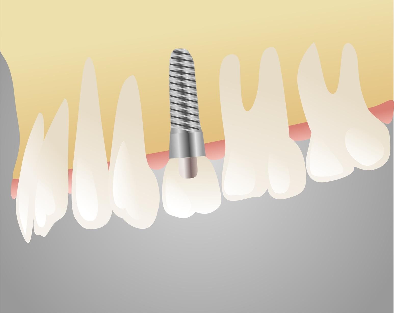 implanty zębowe