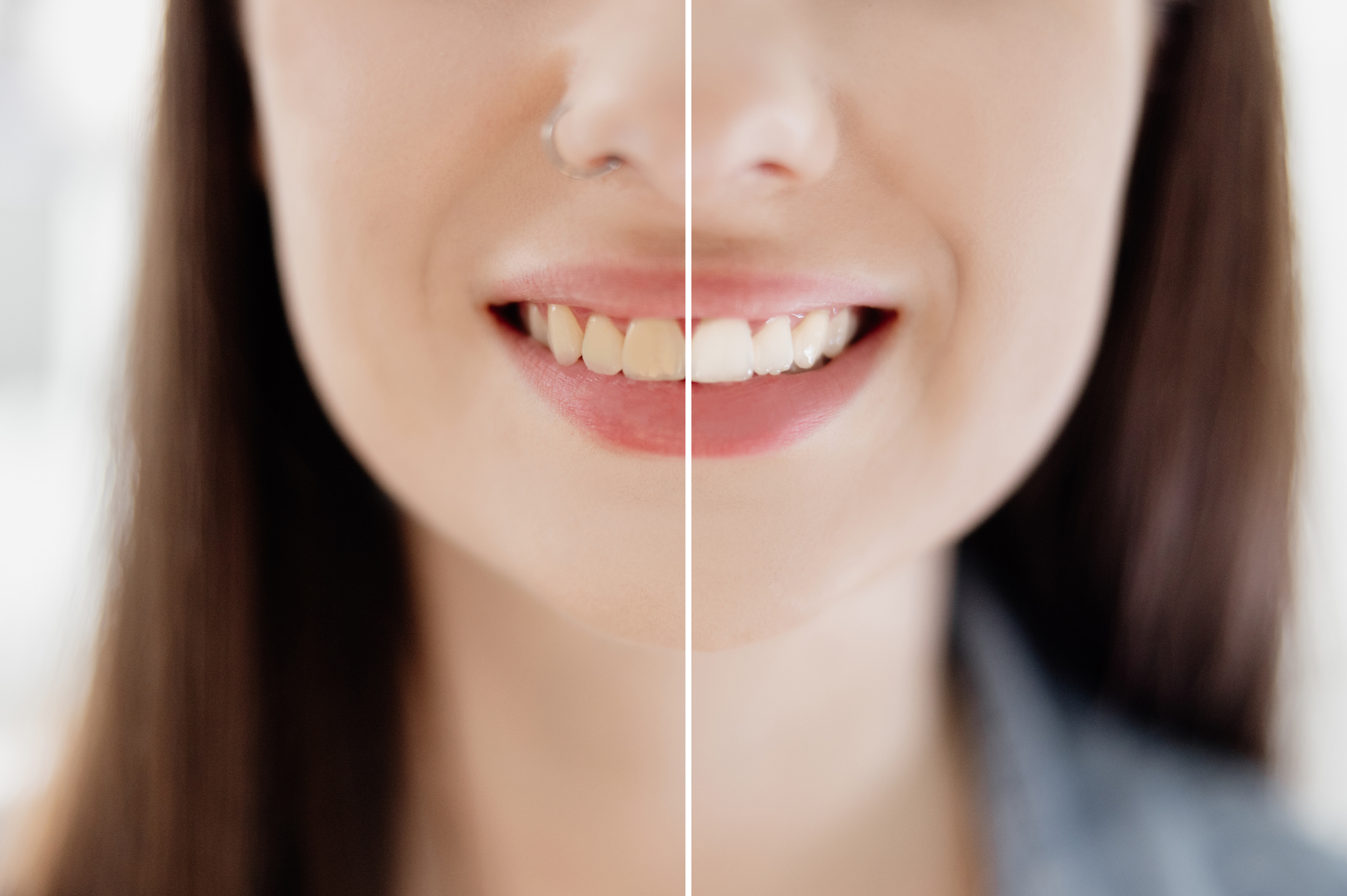 zęby kobiety przed i po wybielaniu